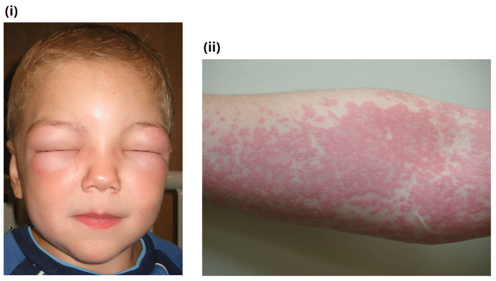 Anaphylaxis Clinical Features Management TeachMeSurgery