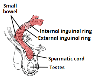 Fig 2 - An inguinal hernia, as depicted here, is a common cause of small bowel obstruction.