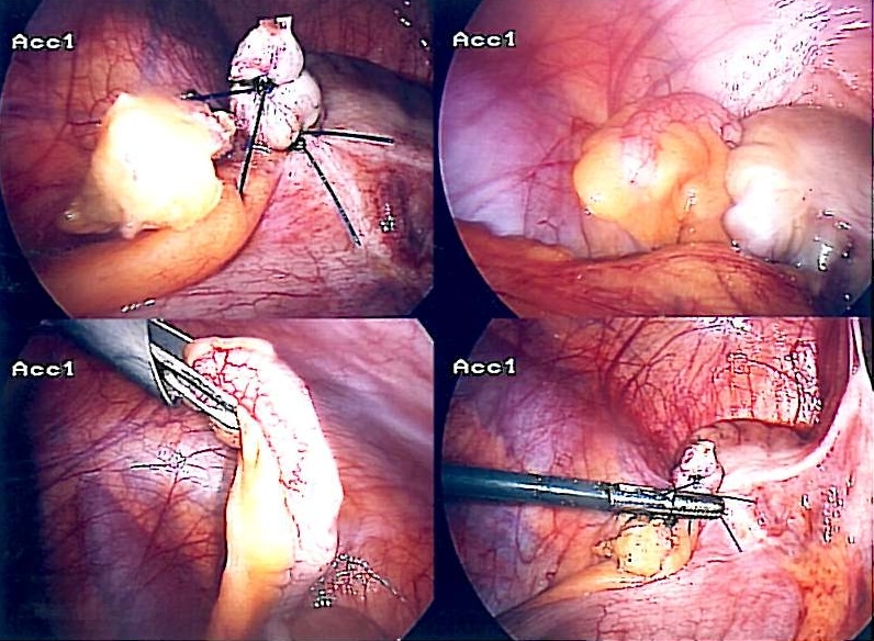 Fig 4 - Laparoscopic appendicectomy.