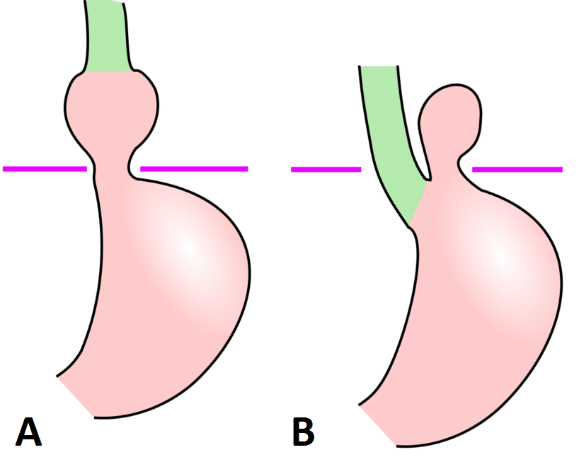 Fig 1 - Types of Hiatus Hernia (A) Sliding (B) Rolling