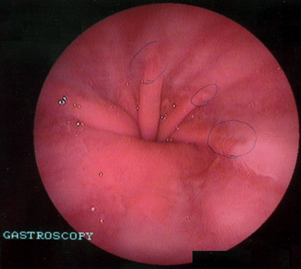 Fig 2 - Endoscopy of Hiatus Hernia, showing upward displacement of the Z-line