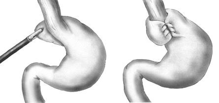Fig 3 - Fundoplication, wrapping the fundus of the stomach around the lower oesophagus and stitching in place