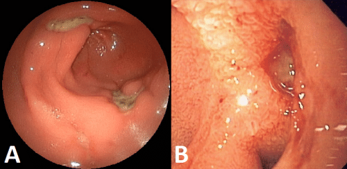 Fig 2 - Features of peptic ulcers on endoscopy (A) peptic ulcer located in the gastric antrum (B) haemorrhaging gastric ulcer