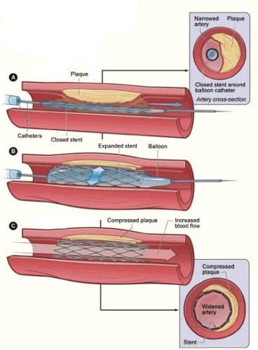 Fig 3 - Angioplasty and stenting. This is one of the surgical options available for the treatment of chronic limb ischaemia.