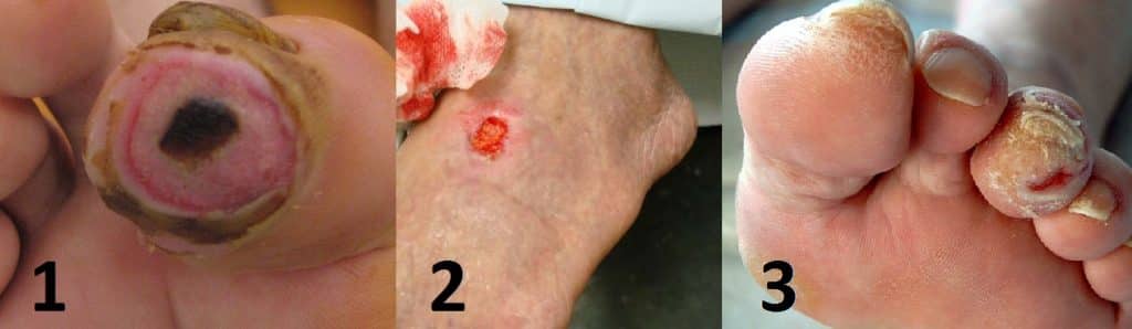 Fig 2- Ischaemic ulcers: well defined edges in peripheral parts of limbs