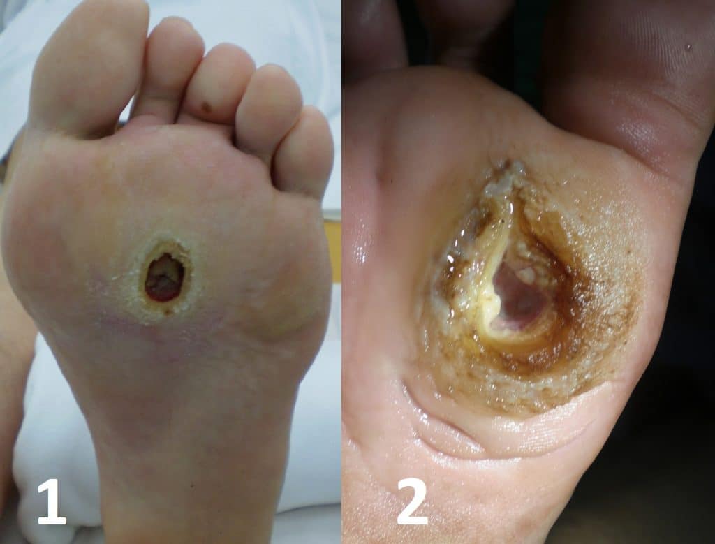 Fig 3 - Neuropathic ulcers, showing the classic 'punched out' appearance