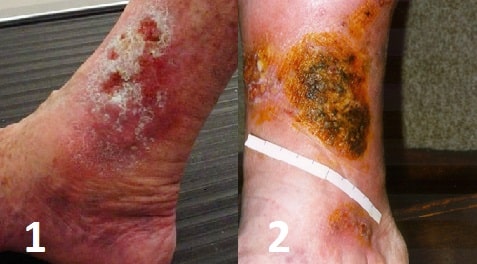 Fig 1 - Venous Ulcers are typically shallow with a granulating base and irregular borders