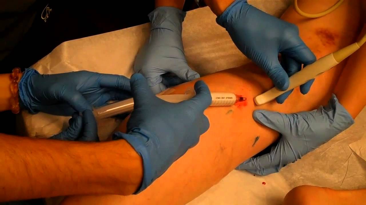 Fig 3 - Foam sclerotherapy, performed under ultrasound guidance.