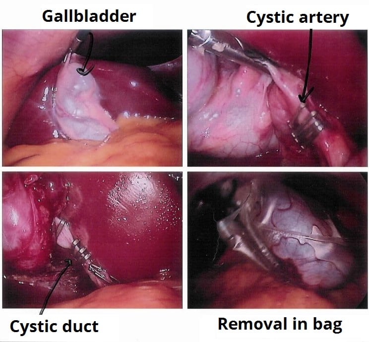 Fig 4 - Images from a laparoscopic cholecystectomy.