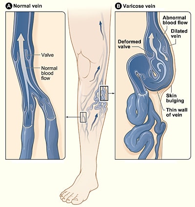 Fig 1 - Varicose veins develop from valvular incompetence, resulting in dilation of the superficial venous system.