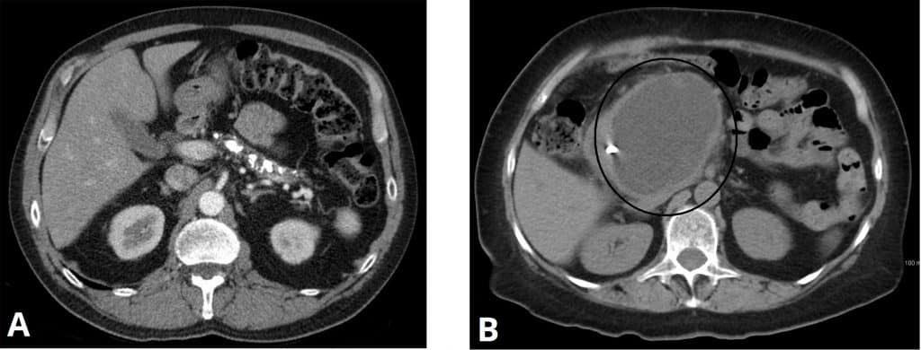 Fig 2 - CT scans in chronic pancreatitis. A - Calcification in the region of the pancreas. B - Large psuedocyst formation
