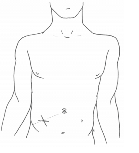 Fig 1 - Lanz (transverse) and Gridiron (oblique) incisions at McBurney's point.