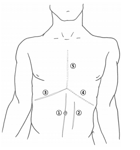 Fig 2 - Common abdominal incisions. ① Midline incision, ② Paramedian incision, ③ Kocher incision, ④ Rooftop modification and ⑤ Mercedes Benz modification.