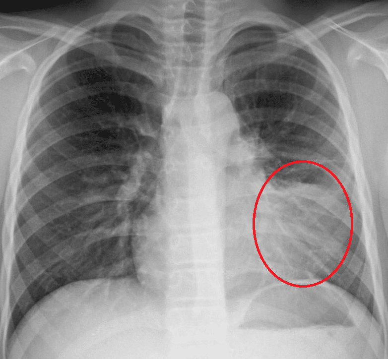 Fig 2 - A CXR showing left lower zone consolidation