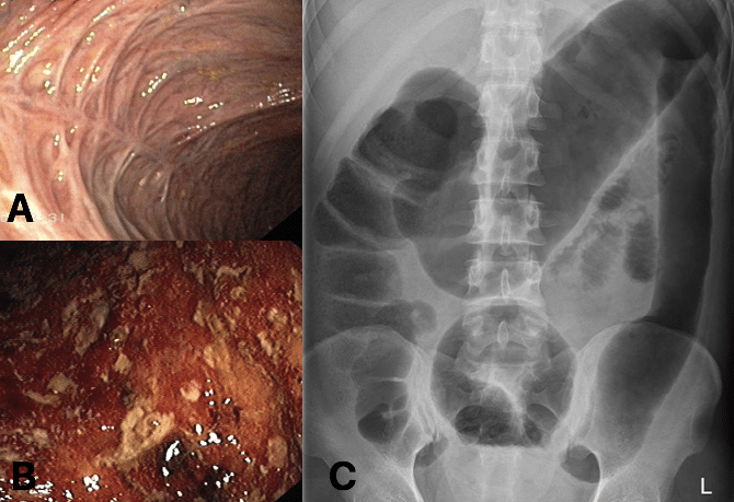 Fig. 3 - (A) bowel fibrosis, secondary to chronic UC (B) active inflammation in patient with UC (C) AXR changes in active UC, showing toxic megacolon with lead-pipe colon ( seen in descending colon)