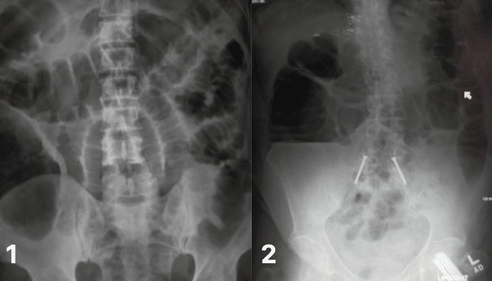 Fig 2 - Bowel obstruction on AXR; (1) Small bowel obstruction, showing valvulae conniventes crossing a dilated, centrally-located bowel; (2) Large bowel obstruction, with peripherally located dilated bowel segments.