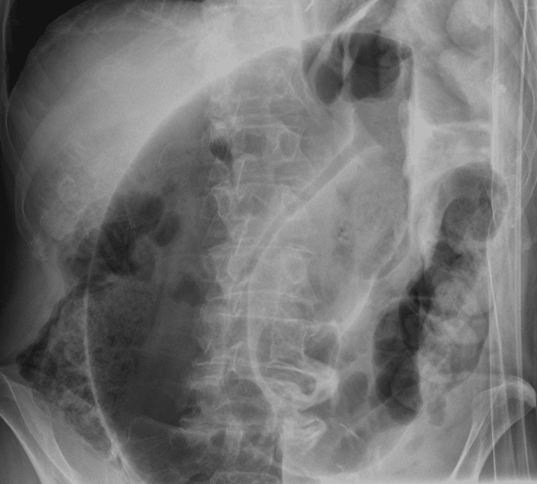Fig. 2 - AXR showing the classic 'coffee bean sign', arising from the left iliac fossa, as seen in sigmoid volvulus