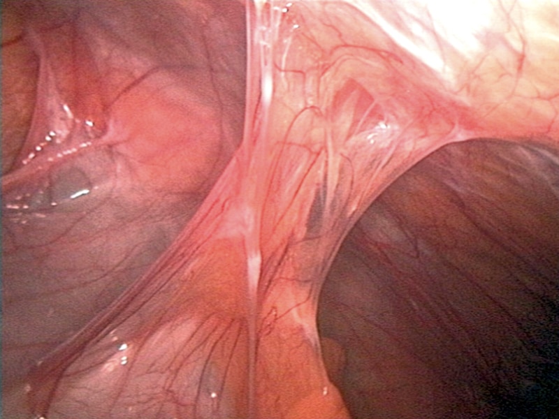 Fig 1 - Bowel adhesions, as seen on laparoscopy, causing a small bowel obstruction