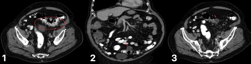Fig. 3 - CT scan for varying degrees of diverticular disease (1) diverticulum in the sigmoid colon (2) degree of diverticulitis present (3) abscess formation, secondary to ongoing diverticulitis