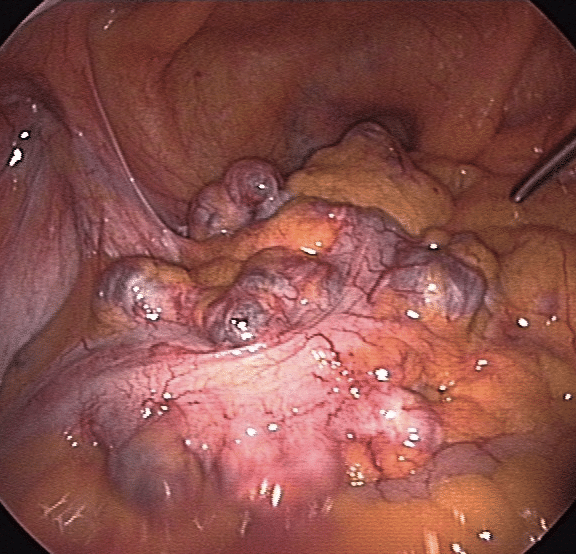 Fig. 1 - Laparoscopic view of diverticula in the sigmoid colon