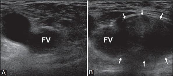 Fig 2 - Ultrasound image demonstrating the typical right femoral hernia emerging medial to a compressed femoral vein (FV). (A) was taken at rest and (B) during Valsalva