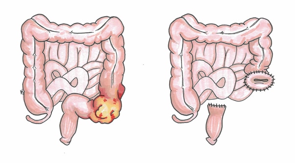 The before and after of the bowel following a Hartmann's Procedure