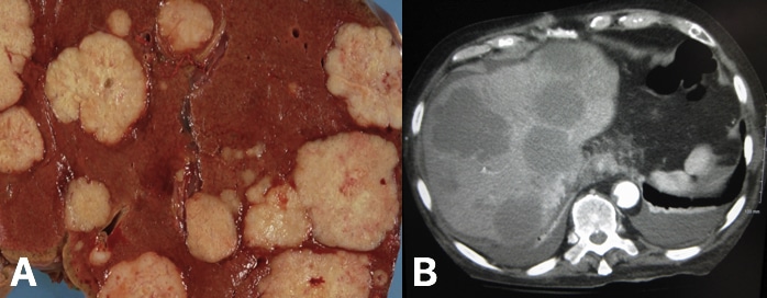 Fig. 4 - Metastatic liver (A) metastatic liver deposits from a colon primary, seen on post-mortem (B) CT scan showing metastatic liver deposits