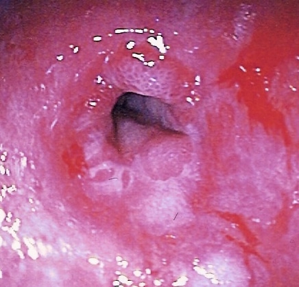 Fig 2 - A non-cancerous peptic stricture, observed on endoscopy.