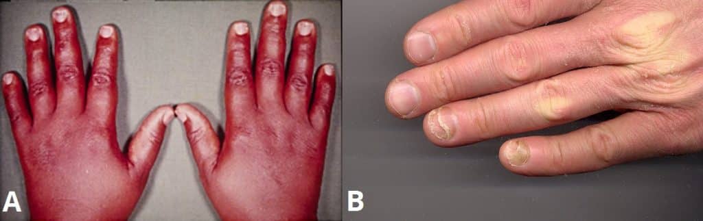 Fig 1 - Features of thyroid disease in the hands. A) Thyroid acropachy - clubbing and swelling of the digits and toes. B) Onychyolysis - separation of the nail from the nail bed.