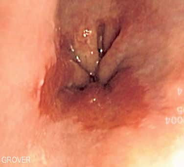 Fig 2 - The endoscopic appearance of Barrett's oesophagus.