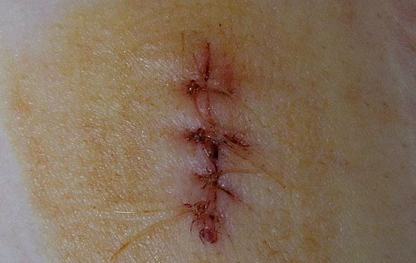 Fig 1 - A surgical wound, closed by sutures. This is an example of healing by primary intention.