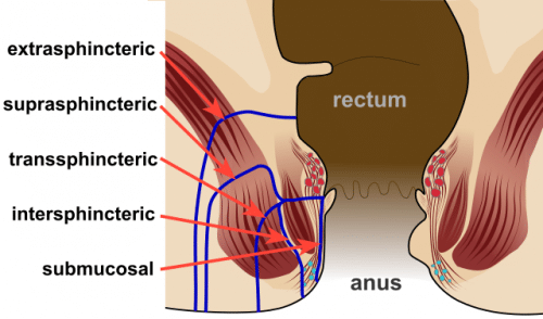 Fig 3 - Diagram highlighting the positions and nomenclature for anorectal fistulae