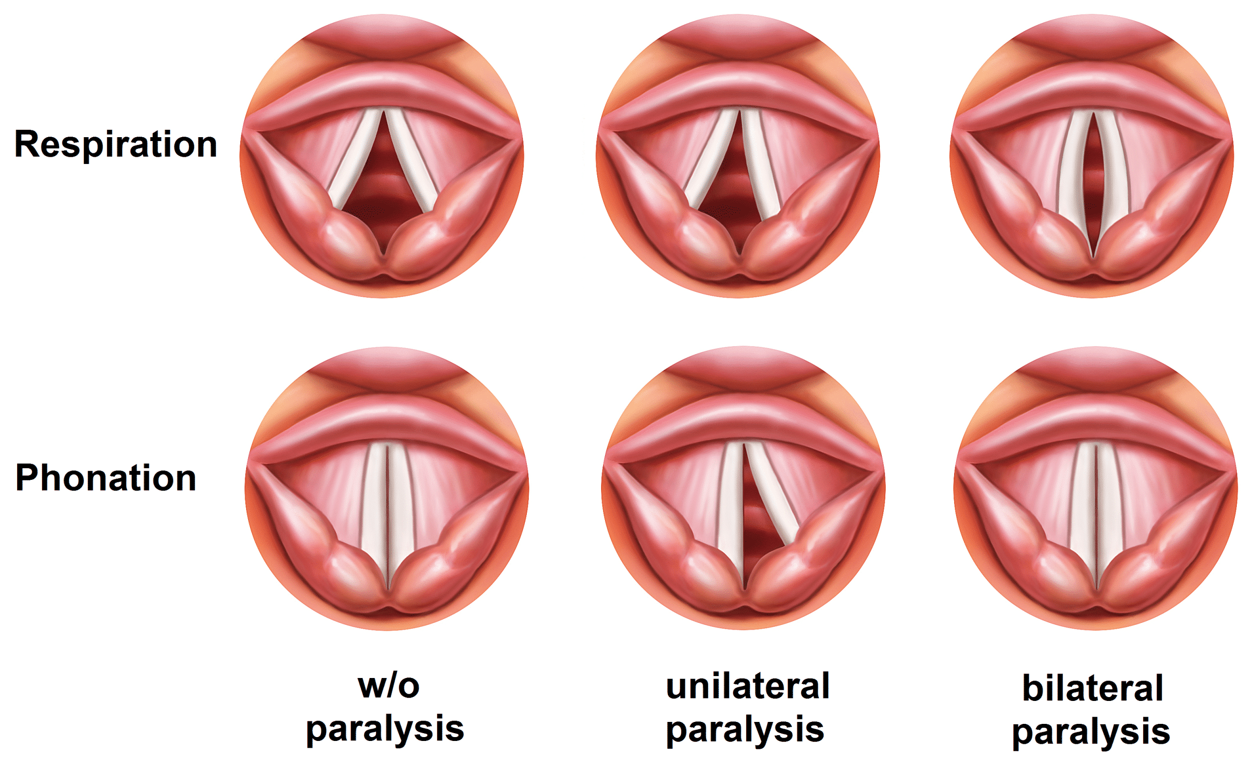 Stammering, its cause and cure . Position of the vocal cordsduring gentle  breathing.. Position of the vocal cordsduring tone production.  Stammering—Its Cause and Cure 9 site for speech is a store of