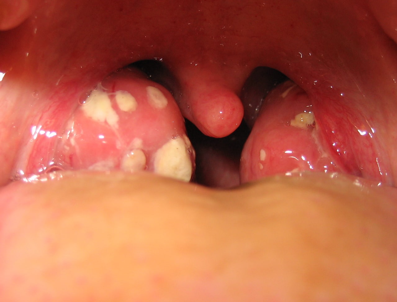 Inside of mouth showing normal throat and tonsils - Stock Image