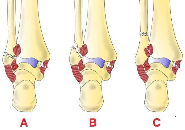 Ankle Fractures - Management - Reduction - TeachMeSurgery