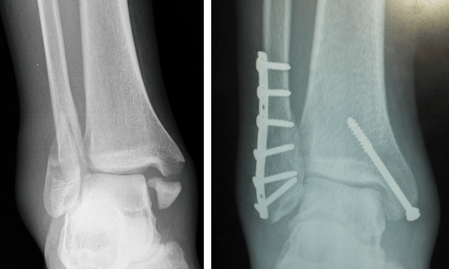 Ankle Fractures Management Reduction Teachmesurgery