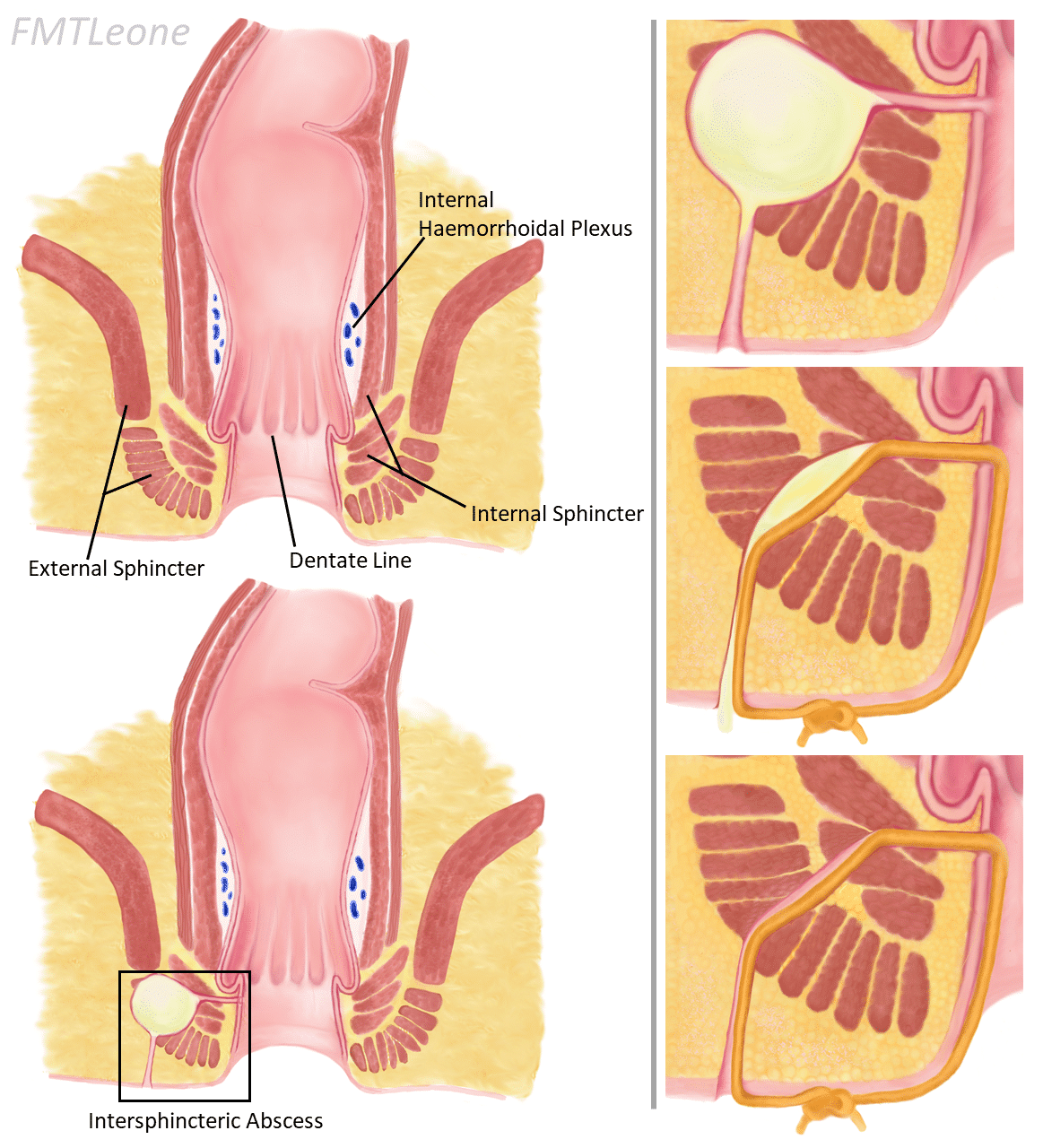 Perineal Fistula Symptoms