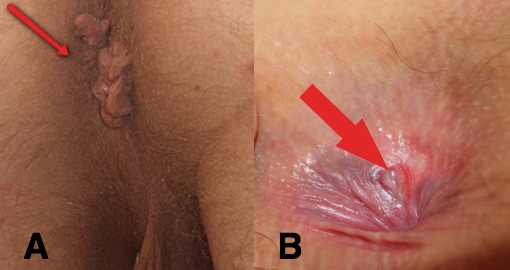 Figure 1 - Findings as seen on DRE (A) Skin Tags (B) Anal Fissure.