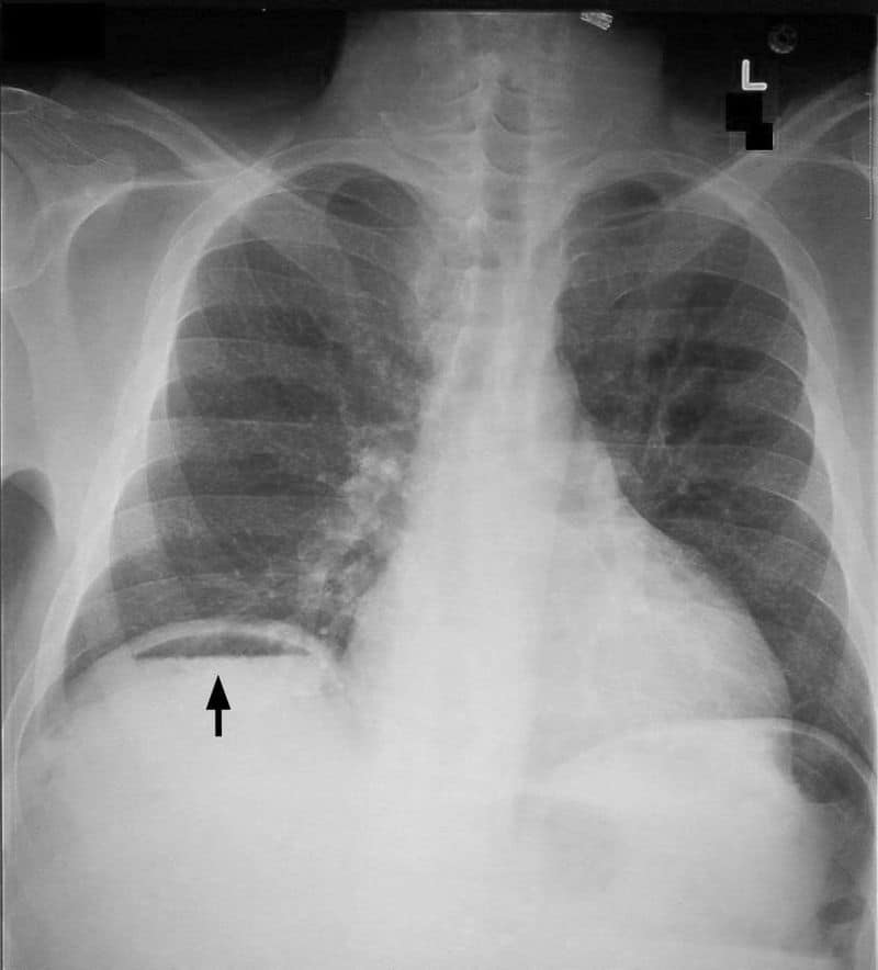 The Acute Abdomen Causes Management TeachMeSurgery The Acute Abdomen Causes Management TeachMeSurgery