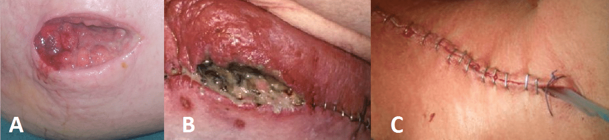 Incision Surgical Site Infection Pictures