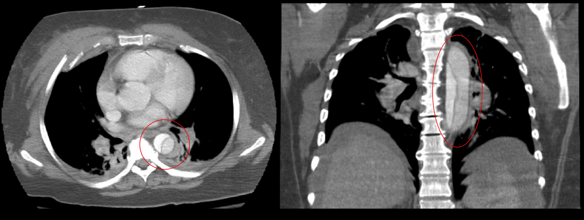 Fig 3 - CT Chest of Stanford Type B Aortic Dissection