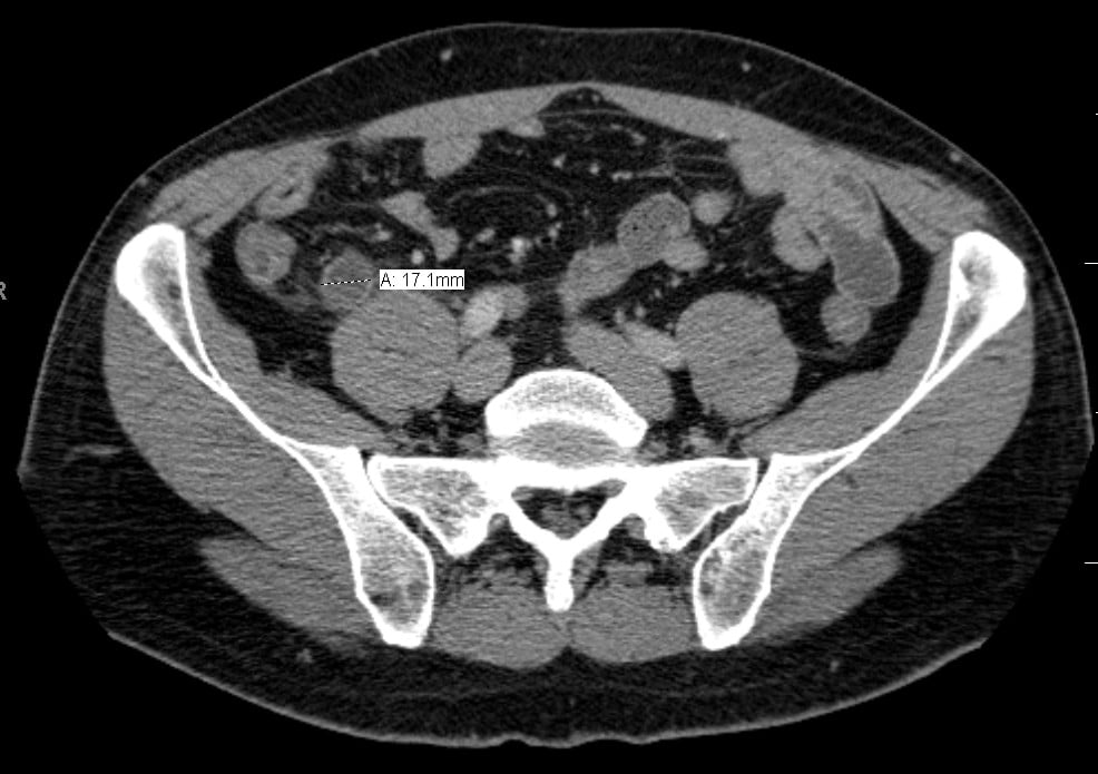 Fig 2 - CT scan showing an acute appendicitis, measuring 17.1mm diameter