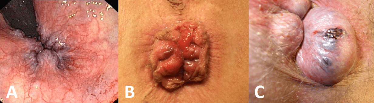 stage ii hemorrhoids internal