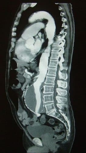 Fig 2 - CT scan showing an abdominal aortic aneurysm.
