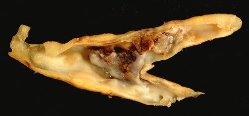 Fig 1 - Atherosclerotic plaque from a carotid endarterectomy specimen