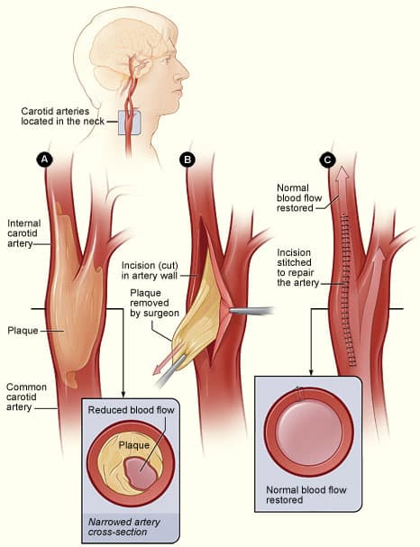 Consent Carotid Endarterectomy Teachmesurgery 3326