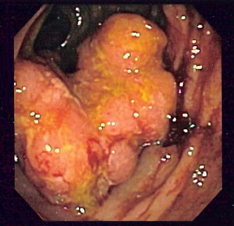 Fig 1 - Endoscopic image of colorectal adenocarcinoma. GI cancers can cause peforation via obstruction, or via direct invasion of the bowel wall.