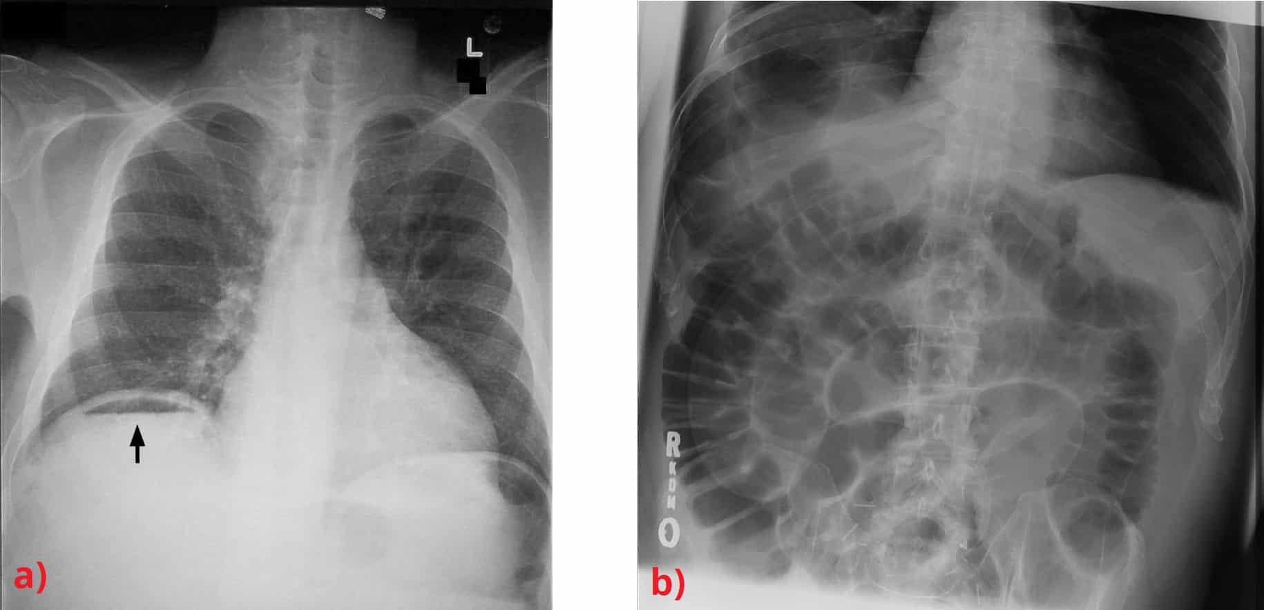 Fig 3 - Radiographic evidence of pnuemoperitoneum. a) Free air under the diaphragm; and b) Rigler's sign.