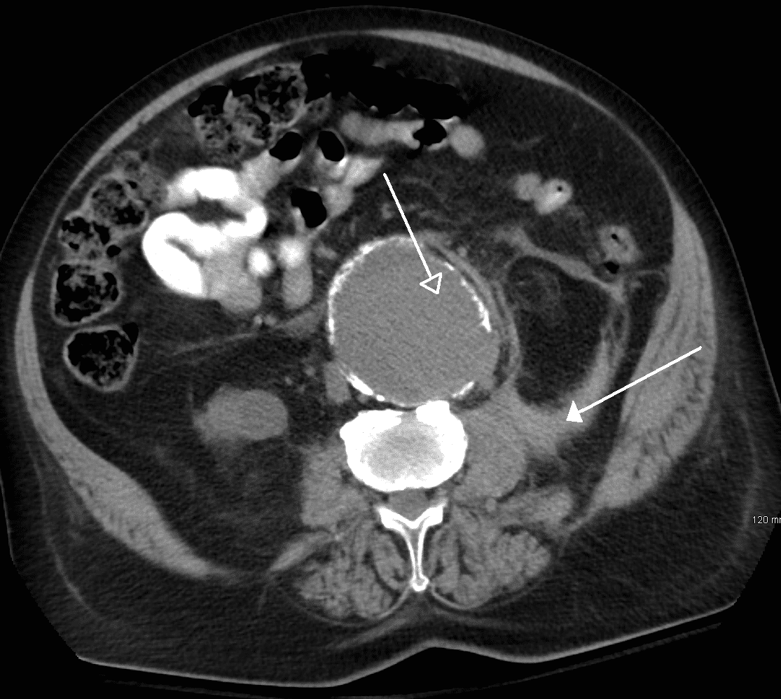 Ruptured Abdominal Aortic Aneurysm Ultrasound