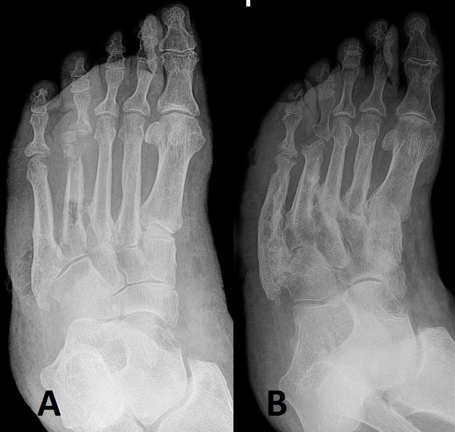 Fig 4 - Charcot foot: (A) initial arthropathy changes; and (B) progressive deformity over 2 years